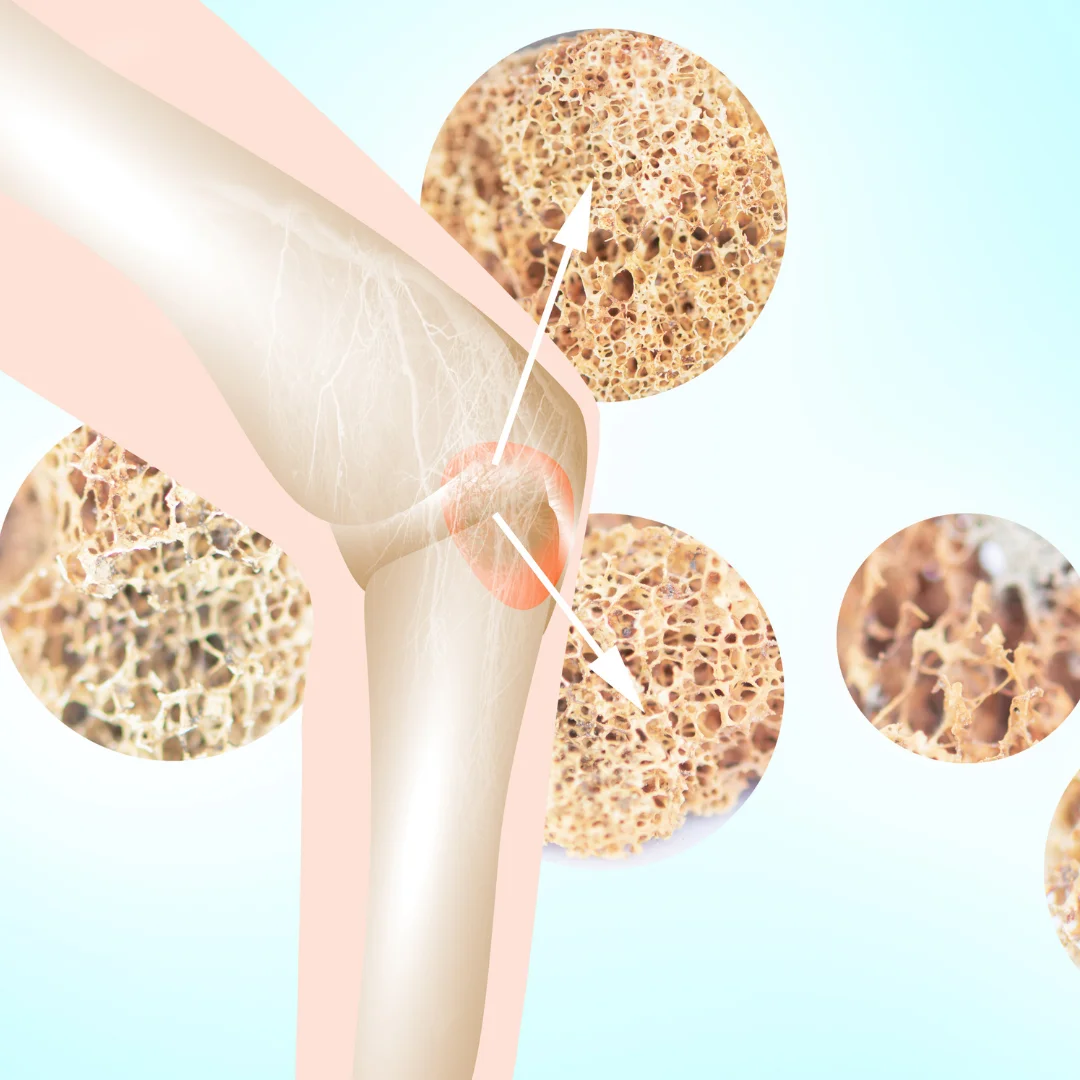 Osteoporosis (Bone Loss)