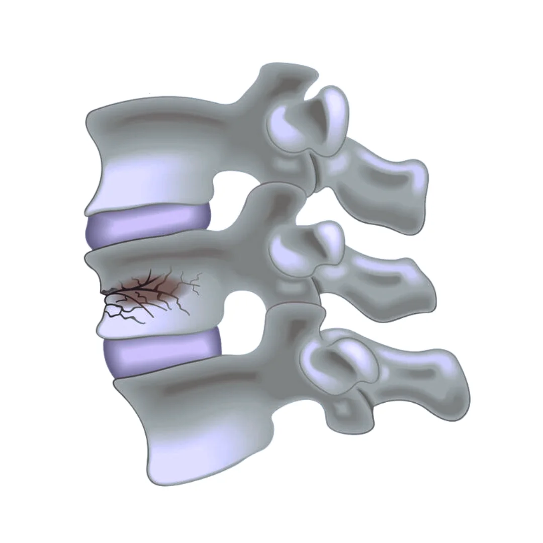 Spinal Fractures