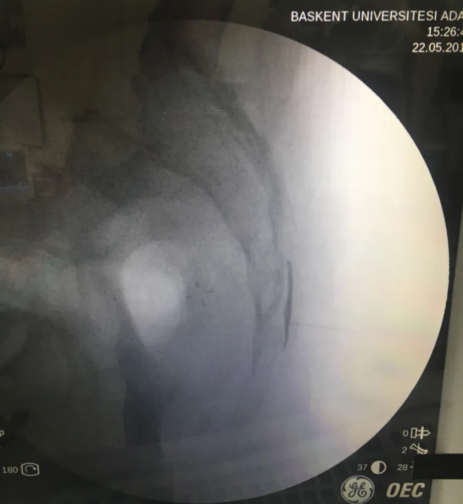 Epidural enjeksiyonun floroskopi altındaki görüntüsü