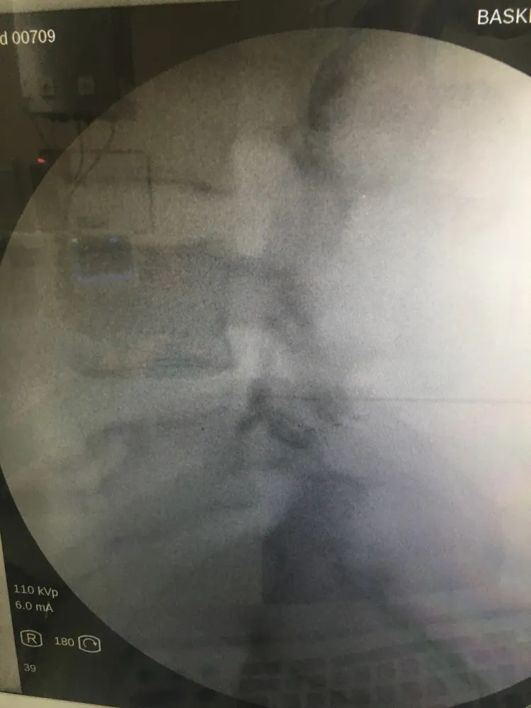 Epidural enjeksiyonun floroskopi altındaki görüntüsü