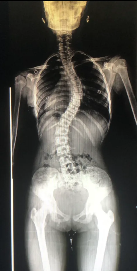 Spine X-ray before vertebral body tethering (VBT) surgery