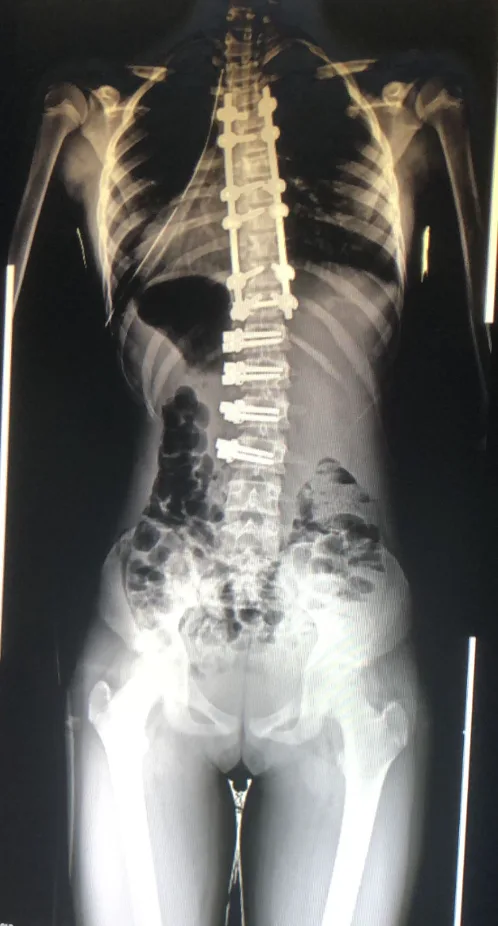 Spine X-ray after vertebral body tethering (VBT) surgery